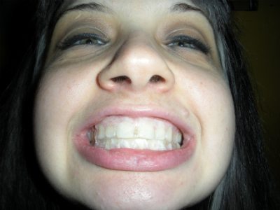 3d whitestrips
